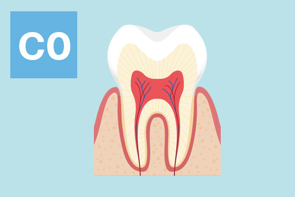 大野歯科の治療方法の説明「むし歯になりかけの歯歯肉炎」