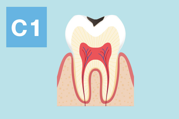 大野歯科の治療方法の説明「歯の表面のむし歯」
