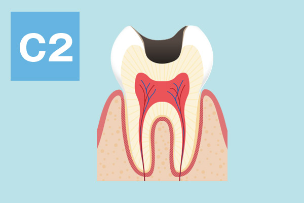 大野歯科の治療方法の説明「神経に近いむし歯」