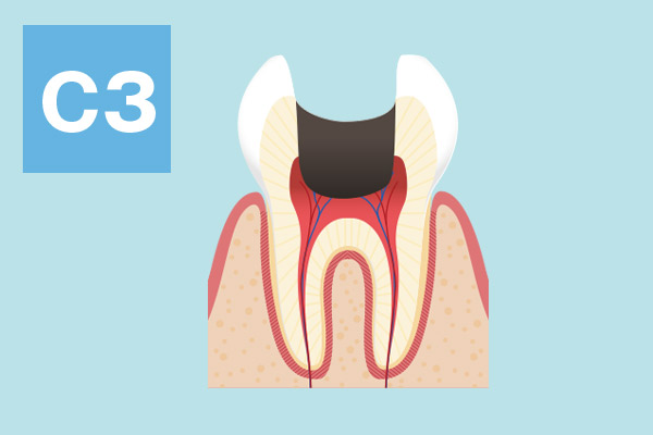 大野歯科の治療方法の説明「神経まで達したむし歯重度歯周炎」