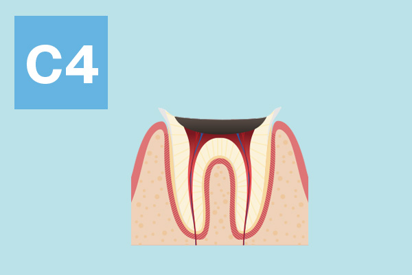 大野歯科の治療方法の説明「末期のむし歯」