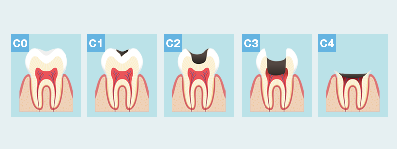 大野歯科の治療方法の説明