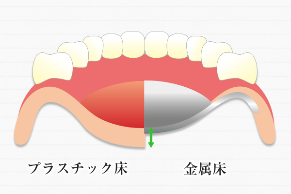 大野歯科の入れ歯についての説明「違和感(薄さ)」