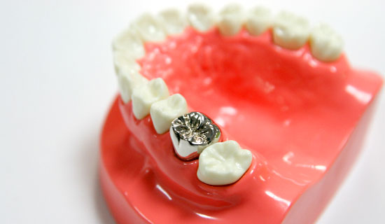 大野歯科の治療メニュー「メタルインレー(銀歯)」