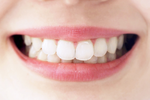 大野歯科の前歯治療の説明「違いその1、美しさ」