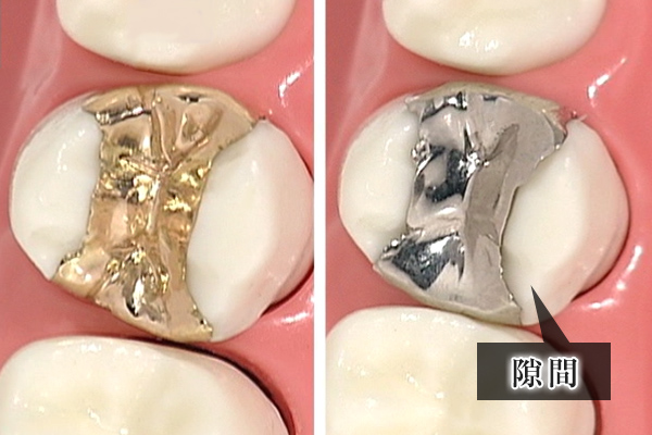 大野歯科の奥歯のつめものの説明「その2、耐久性」