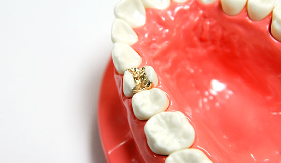 大野歯科の治療メニュー「ゴールドインレー」