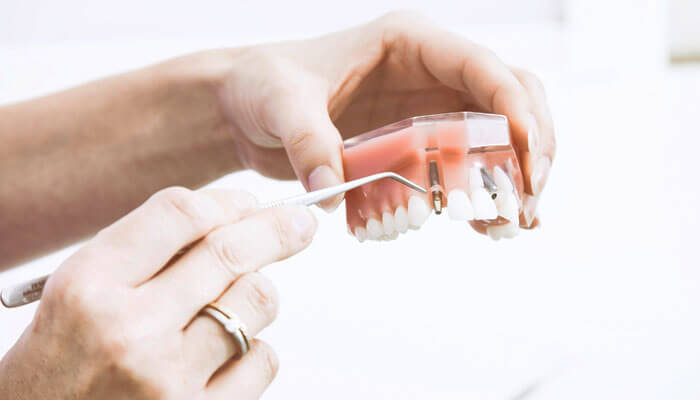 インプラント治療に関するイメージ画像‗歯科医師が顎模型を持ち、インプラント体を指して説明している写真