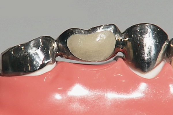 大野歯科の失った歯を補う治療の説明「ブリッジ」