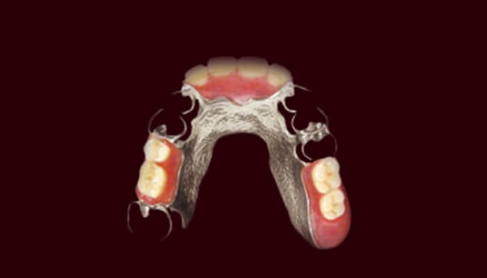大野歯科の入れ歯についての説明「コバルトクロム床義歯」