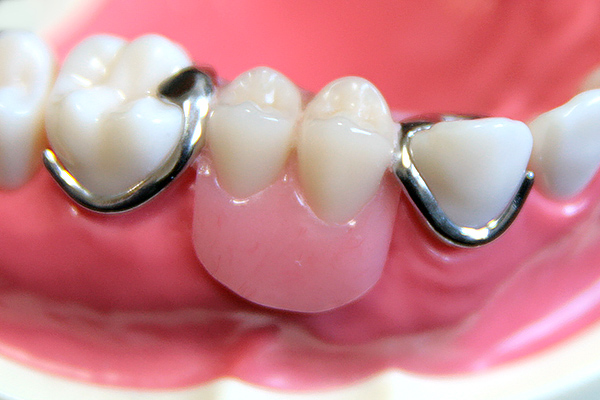 大野歯科の失った歯を補う治療の説明「入れ歯」