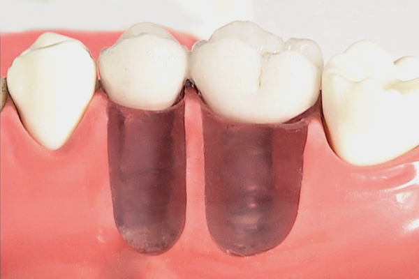 大野歯科の治療説明「インプラント」