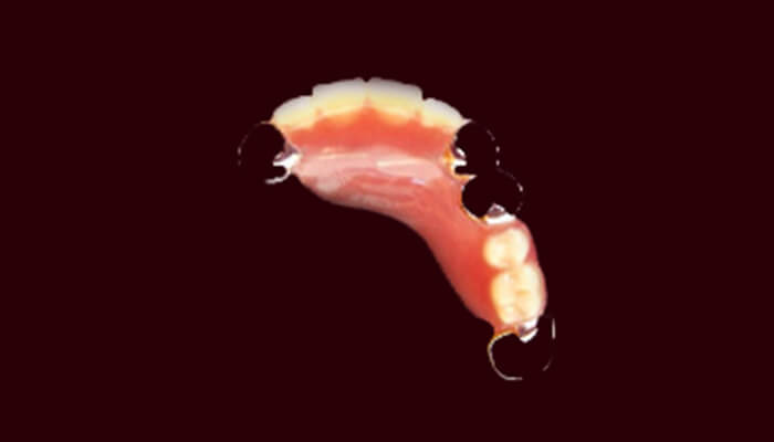 大野歯科の入れ歯についての説明「プラスチック義歯」