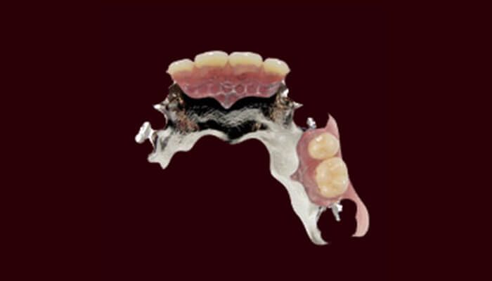 大野歯科の入れ歯についての説明「チタン床義歯」