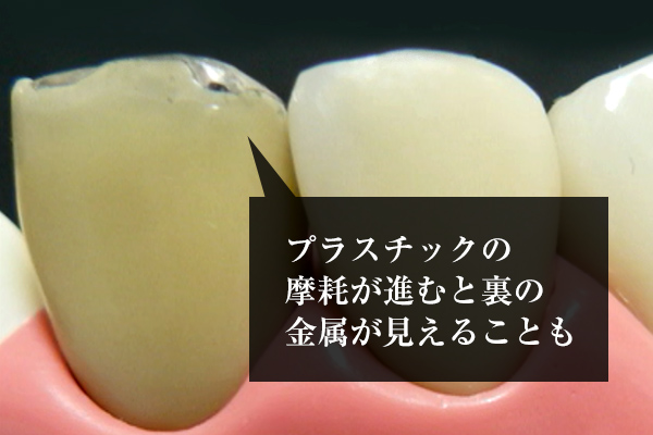 大野歯科の前歯治療の説明「違いその2、耐久性」